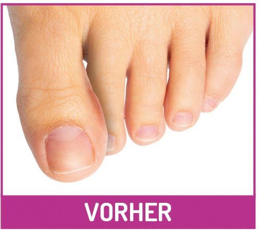 Fußgut Zehenkorrektor Zehen-Distanz-Schiene, gegen Druckstellen, Reibung, Blasen, Set 2-tlg., 1 Paar, hilfreich bei Zehenfehlstellungen, Hammerzehen, Hühneraugen