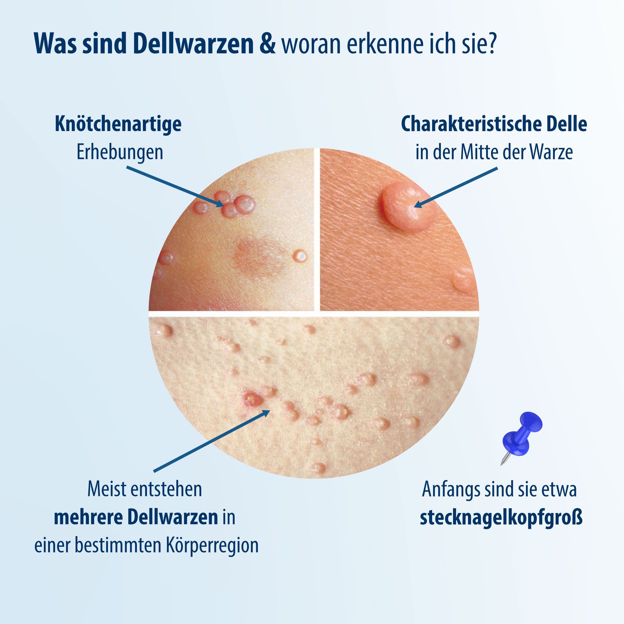 Evolsin Warzen-Behandlungsstift Evolsin® Dellwarzen Mittel I Sanfte & Effektive Dellwarzen Behandlung
