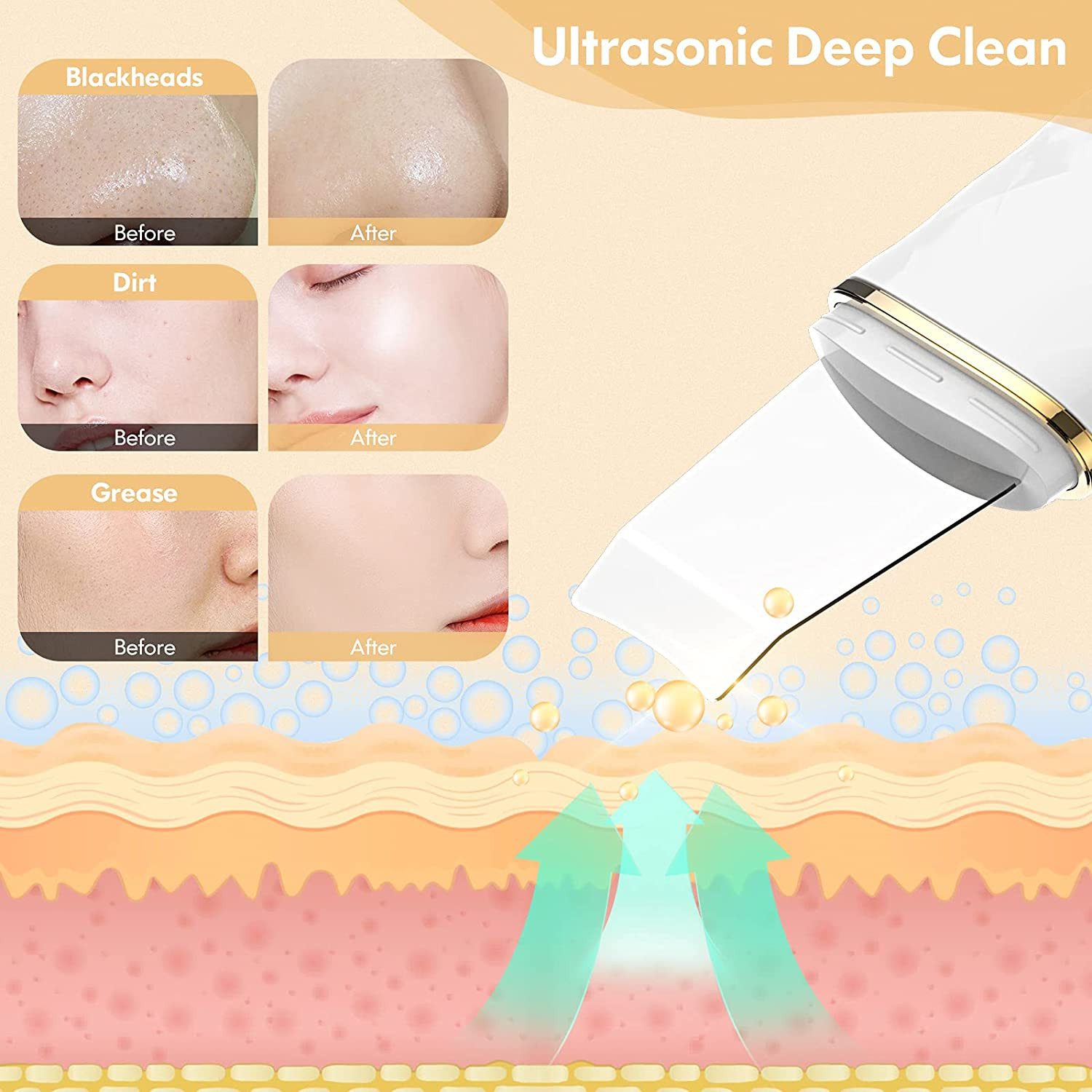 Forrlite Dermaroller Ultraschallpeelinggerät, Gesichtsspatel Tiefenreinigung, Ultraschall-Peeling Porenreiniger Akne-Entferner Ionen Hautreiniger, Pickel und Akne Entferner set, Mikrodermabrasionsgerät