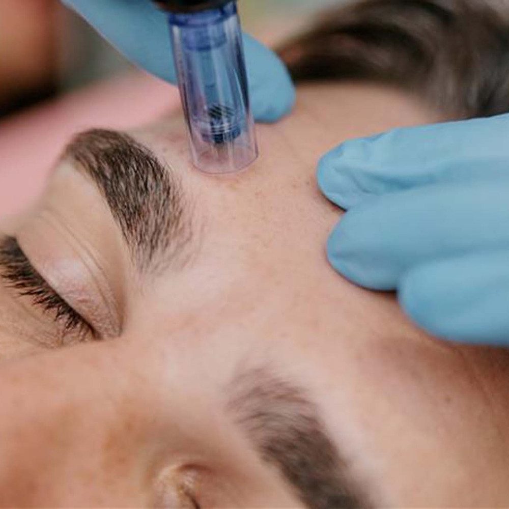 Jochen Schweizer Erlebnisgutschein Microneedling Ingolstadt, Strahlende Haut trifft High-Tech in Ingolstadt