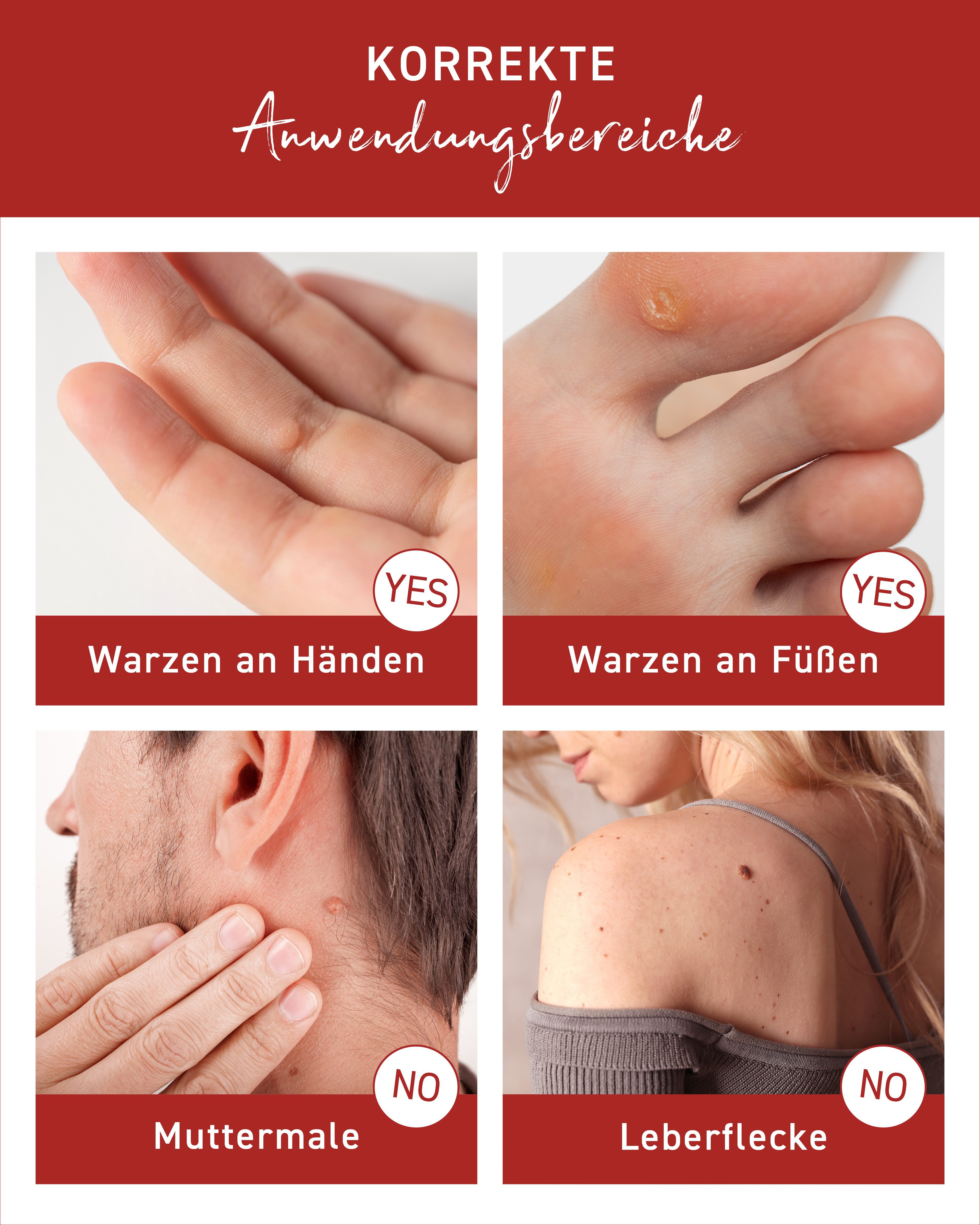 N1 Healthcare Warzen-Behandlungsstift N1 Warzen Tinktur, 2 ml, Medizinprodukt aus der Apotheke