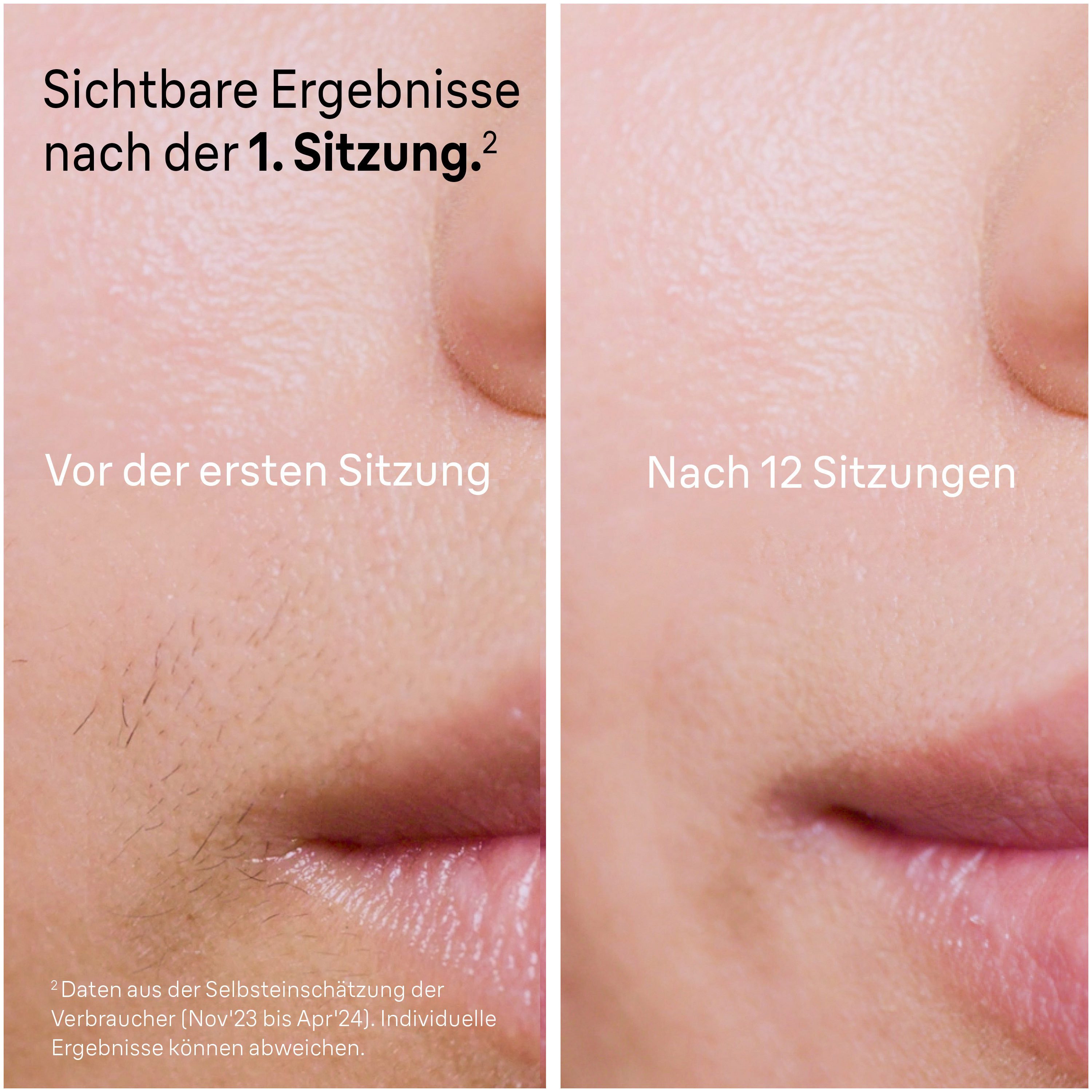 Braun IPL-Haarentferner Smart Skin i·expert PL7147, 2 Aufsätze für Gesicht & Körper, Venus Rasierer & Aufbewahrungstasche