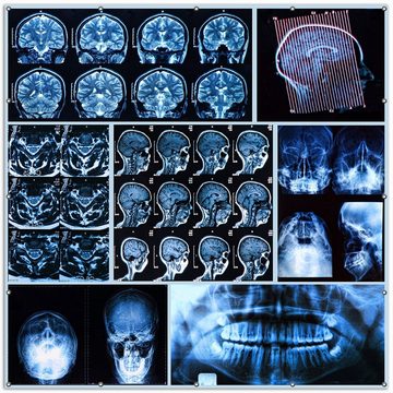 Wallario Sichtschutzzaunmatten Röntgen-Bilder eines menschlichen Kopfes von allen Seiten, 2-teilig