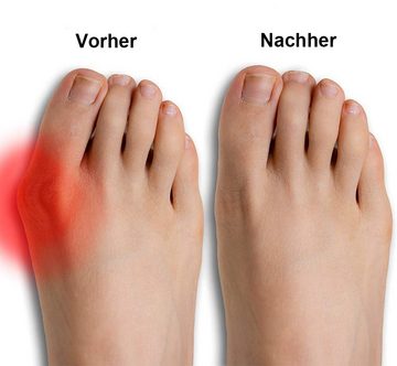 Alster Herz Hallux-Bandage Korrektur Set, Hallux Valgus Schiene mit Protektoren aus Silikon, 1-tlg., lindert Schmerzen bei Hallux Valgus