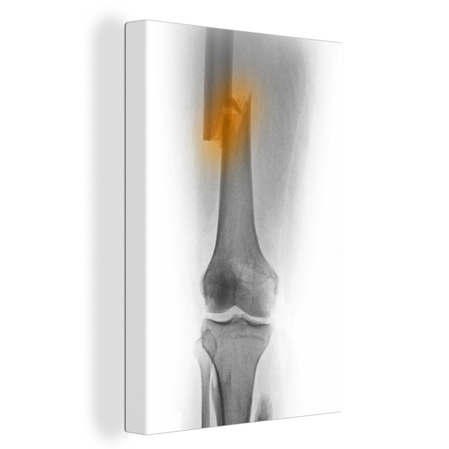 OneMillionCanvasses® Leinwandbild Röntgenbild des Oberschenkels eines 30-jährigen Mannes, der in einen, (1 St), Leinwandbild fertig bespannt inkl. Zackenaufhänger, Gemälde, 20x30 cm