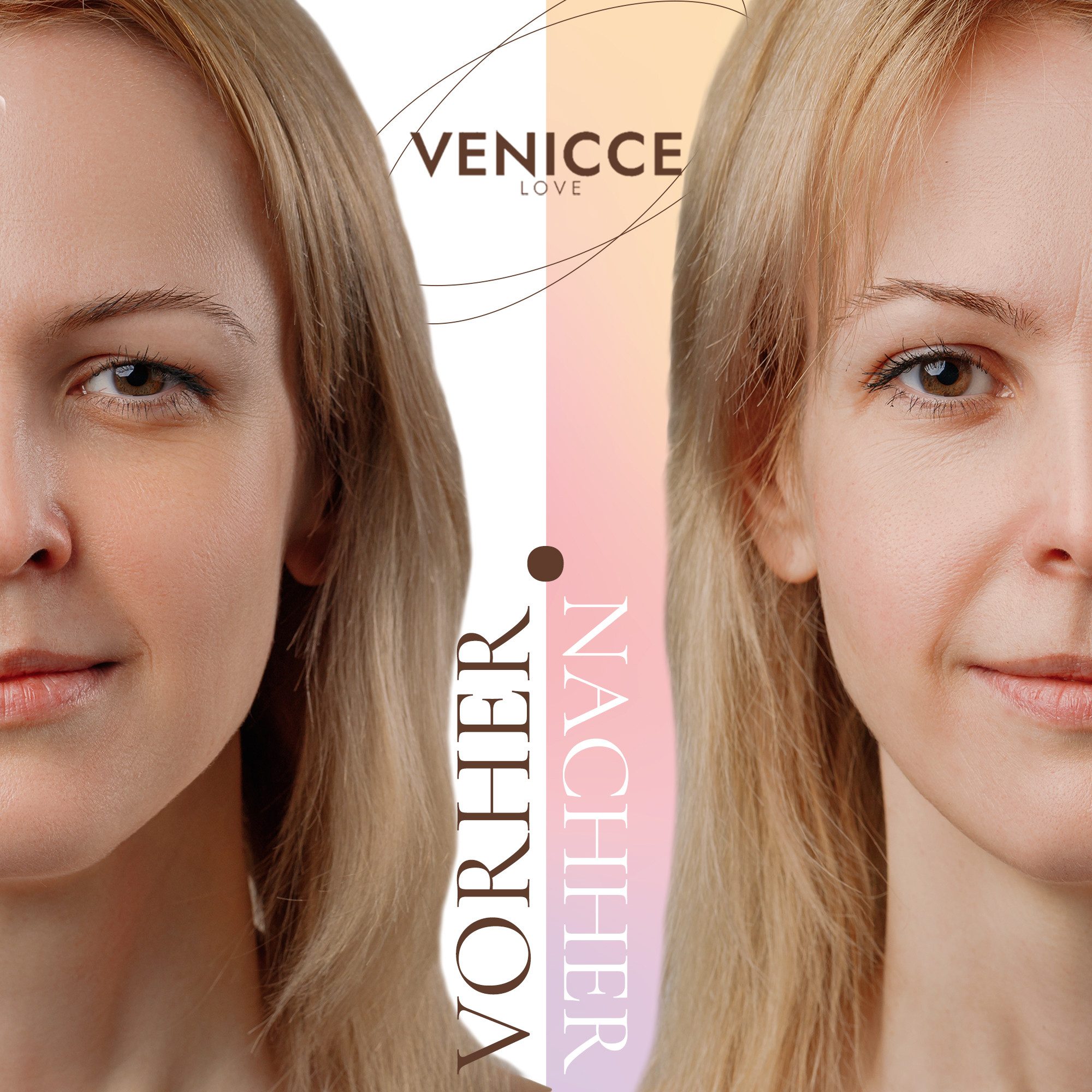 Venicce Love Augenlid-Tape Augenlid Stripes gegen Schlupflider und hängende Augenlider ohne OP (144-St) Augenlid Tapes zur optischen Verschönerung der Augenpartie