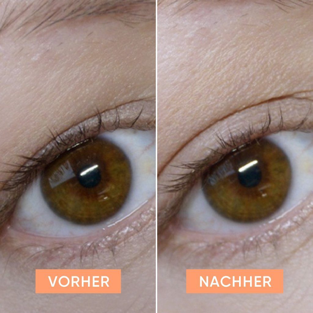APRICOT Beauty gegen Tapes Augenpatches Eyelid hängende Augenlider - APRICOT Schlupflidtape
