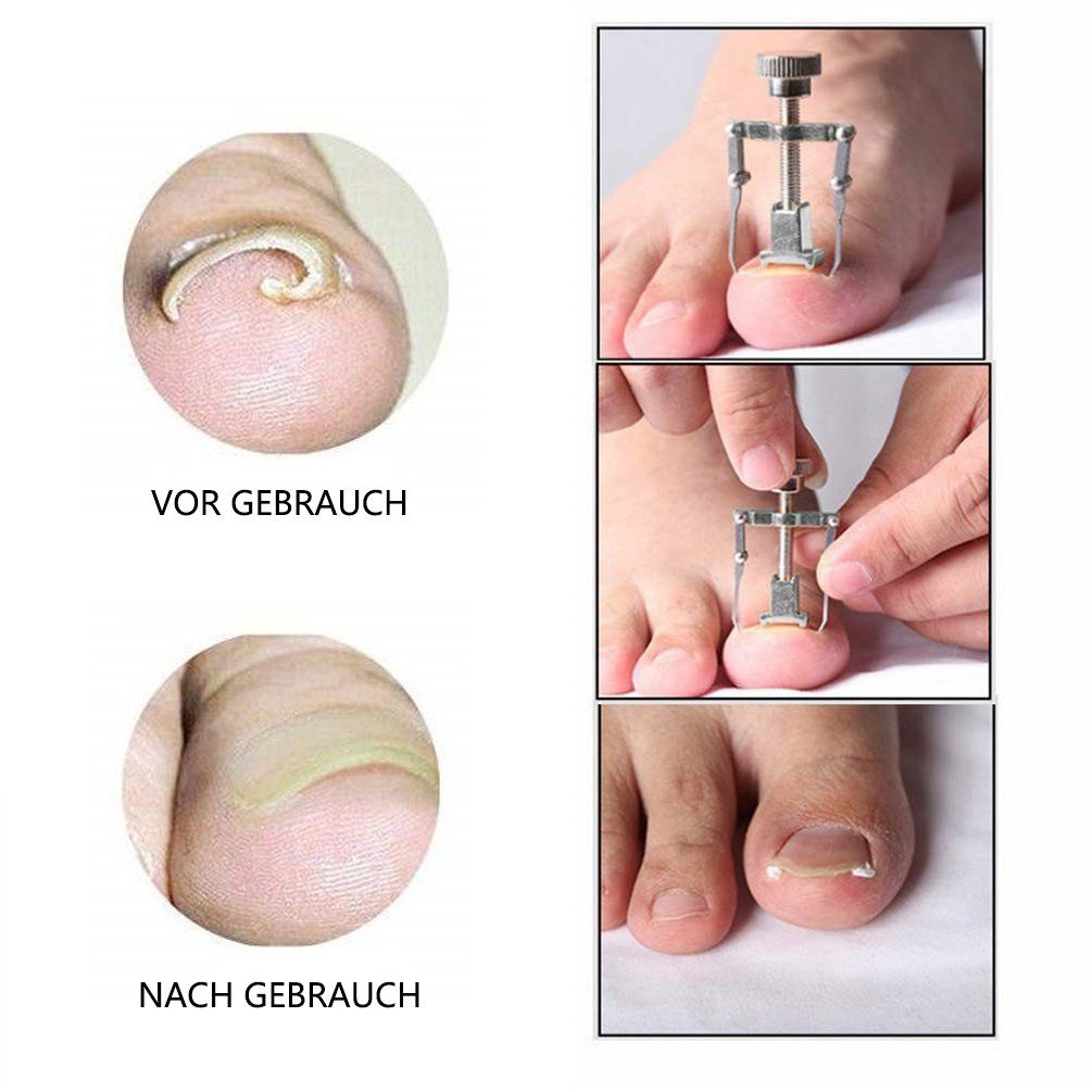 COOL-i ® Maniküre-Pediküre-Set 42-teiliges Eingewachsene-Zehennägel-Pflegeset, Nagelkorrektor & Hilfsmittel für schmerzfreie Fußpflege zu Hause