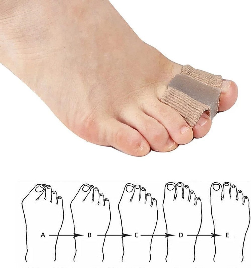 Hallux Valgus Zehenspreizer Aus Silikon – 4 Stück, Für Ballenschmerzen