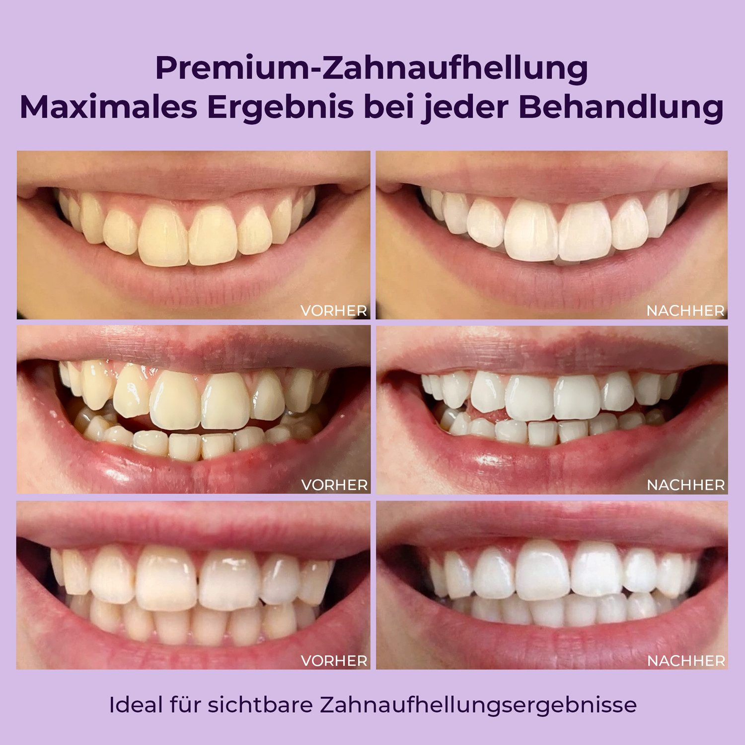 OnlySmile Zahnbleaching-Kit Zahnaufhellung Set - Testsieger - Teeth Whitening Kit für Weiße Zähne, Zahnaufhellung, Bleaching Set, Aufhellen, ideal für Zuhause