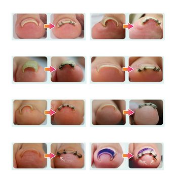 Minadax Nagelzange 2x NailLift Korrekturspange Für Eingewachsene Zehennägel