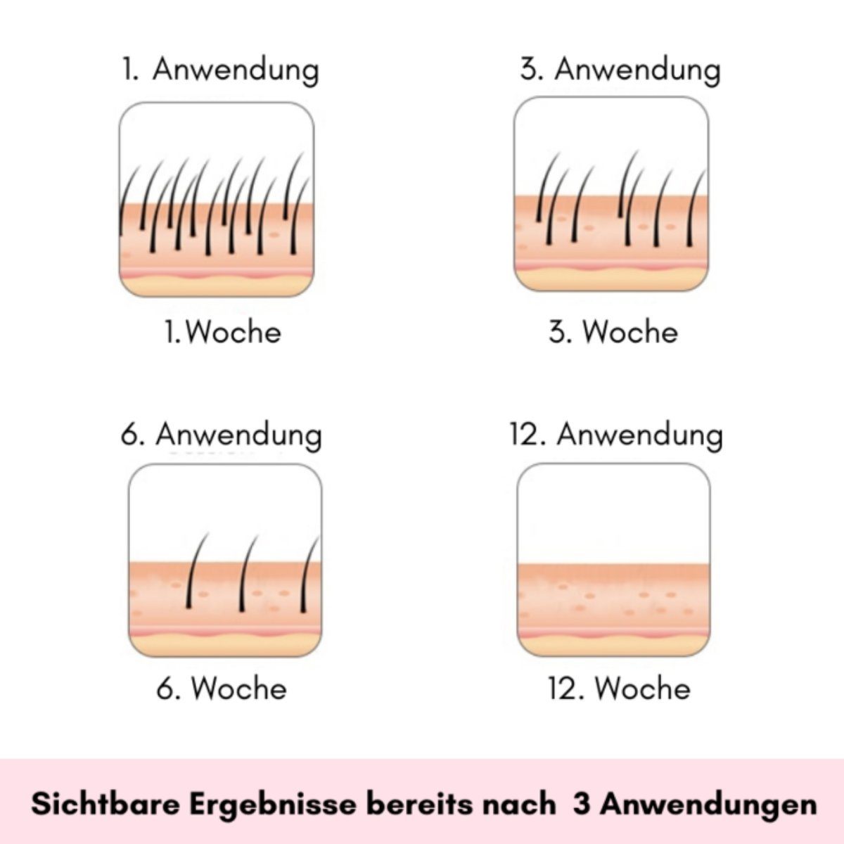 Wonder Skin IPL-Haarentferner IPL Hair Laser PRO (2 Modi) mit 999.999 Lichtimpulsen, 999.999 Lichtimpulse, Dauerhafte Haarentfernung am ganzen Körper, schmerzfrei