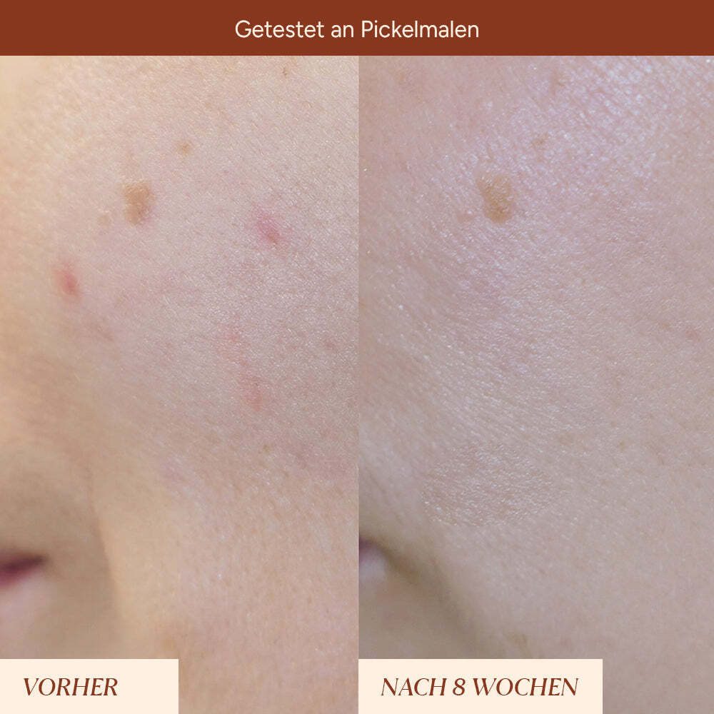JUNGLÜCK Gesichtsserum Pigmentflecken & Pickelmale Roll-On, 1-tlg., Entdecke unseren Hero für ein ruhigeres Hautbild!
