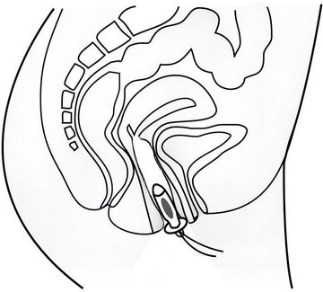 promed Beckenboden-Elektrostimulationsgerät IT-6, Inkontinenz-Therapiegerät