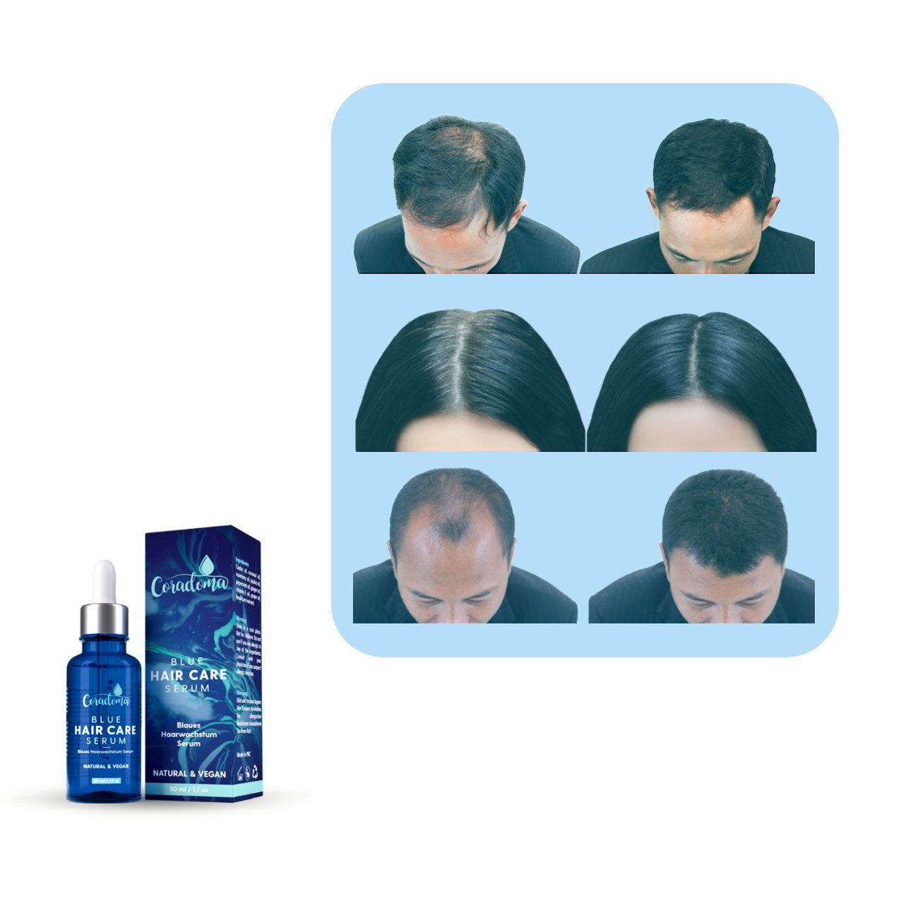 Serum Coradoma Frauen für 50ml Beschleunigen, Haarwachstum Haarserum Männer, Blaues und Haarausfall Anti