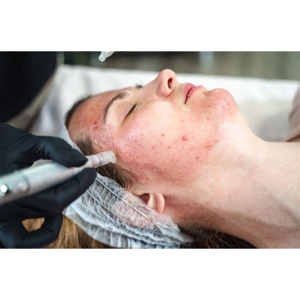 Jochen Schweizer Erlebnisgutschein Microneedling Ingolstadt, Strahlende Haut trifft High-Tech in Ingolstadt