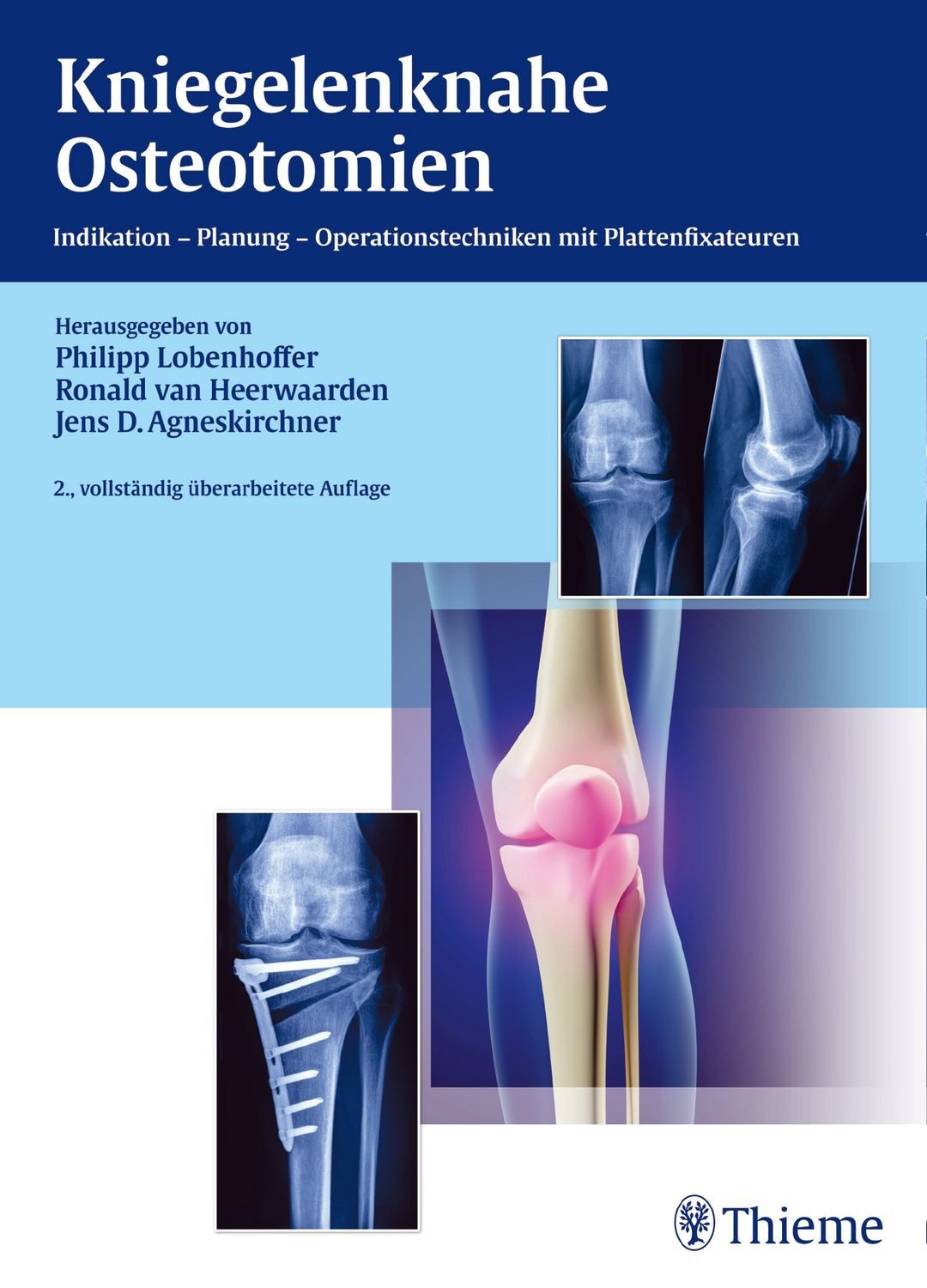Kniegelenknahe Osteotomien / diverse