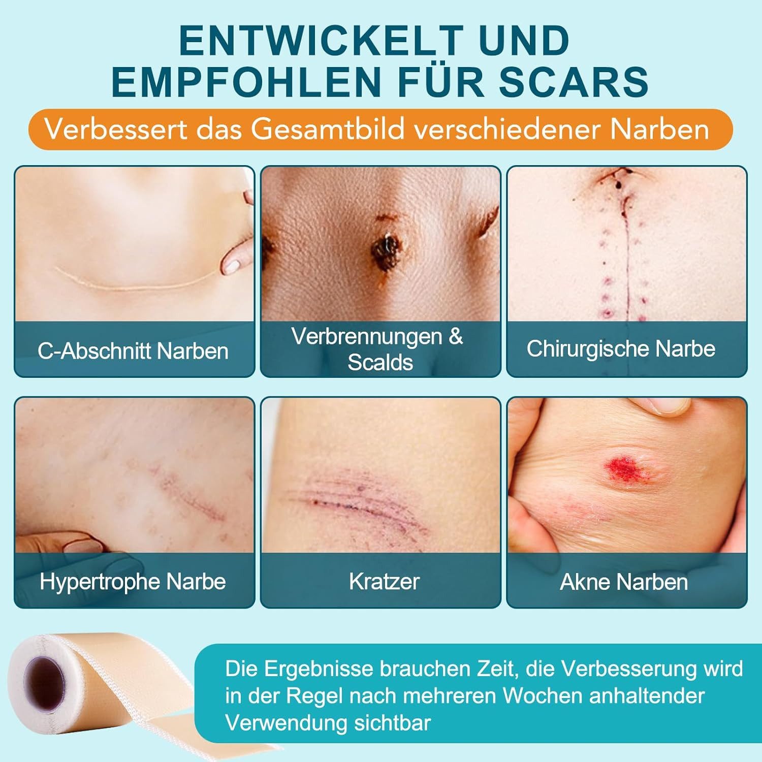 NEXGEN LUXUS SCHÖNHEIT & HAUTPFLEGE Wundpflaster Silikon Narbenpflaster, Silicone Scar Tape (4 cm x 190 cm)