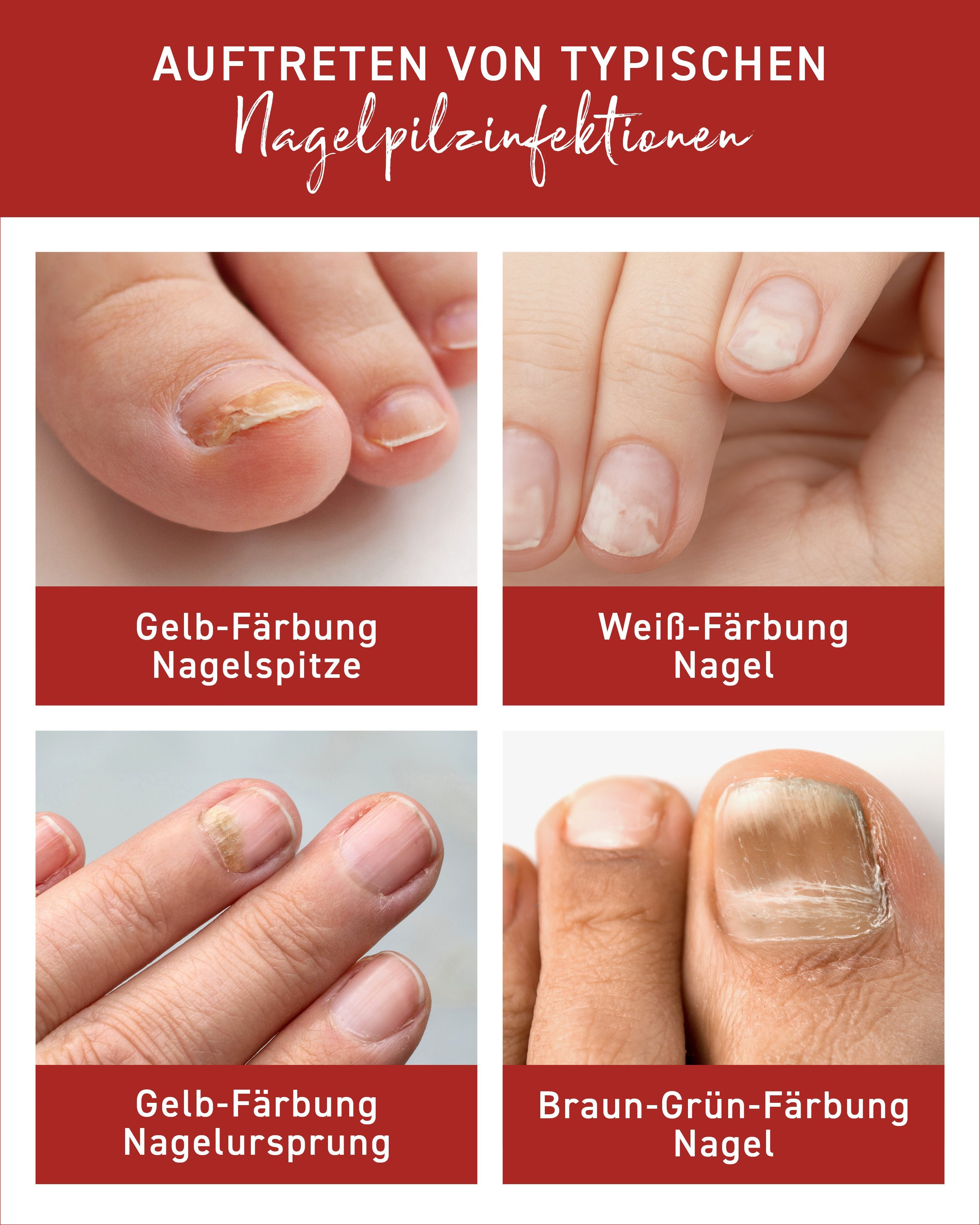 N1 Healthcare Nagelpilz-Behandlungsstift N1 Nagelpilzlösung mit patentiertem Wirkstoff, 10 ml, Effektive und pflegende Behandlung gegen Nagelpilz am Händen und Füßen
