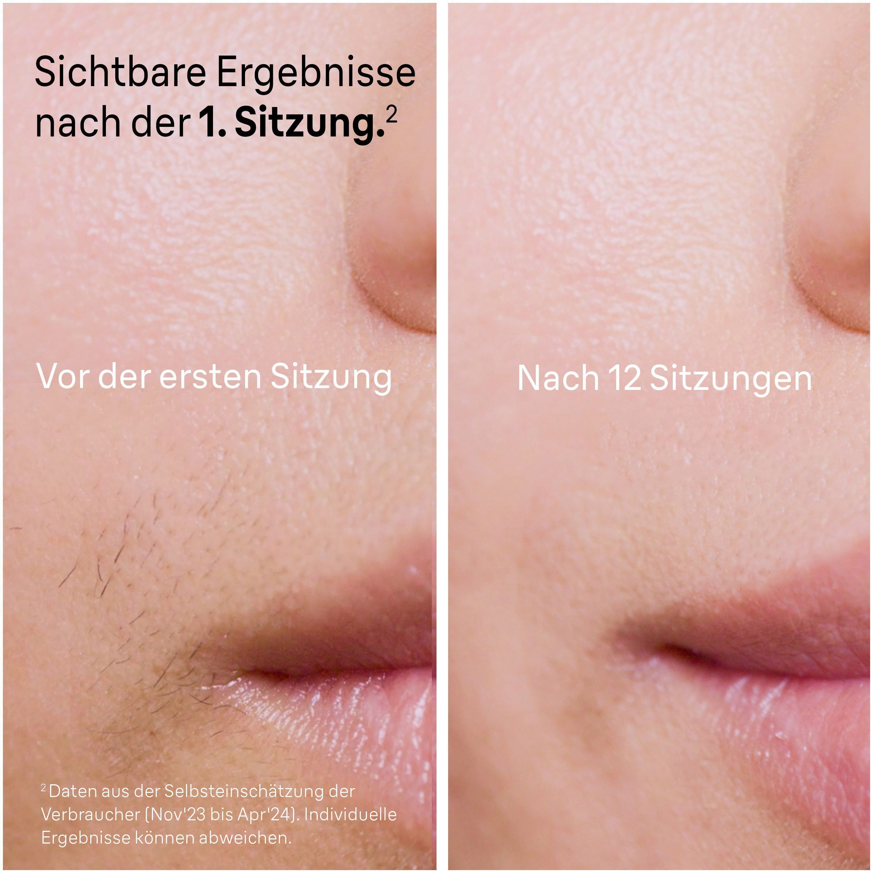 Braun IPL-Haarentferner Smart IPL Skin i·expert PL7387, 4 Aufsätze, Haarentfernung für zu Hause, Gratis App, Aufbewahrungstasche