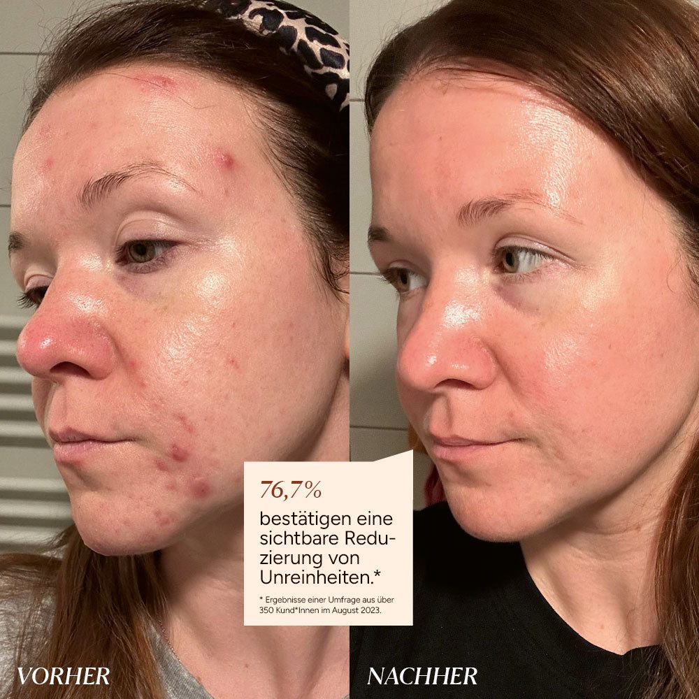 JUNGLÜCK Gesichtsserum Azelain Serum - 10% azelaic acid, 1-tlg., Wirkt gezielt gegen Unreinheiten