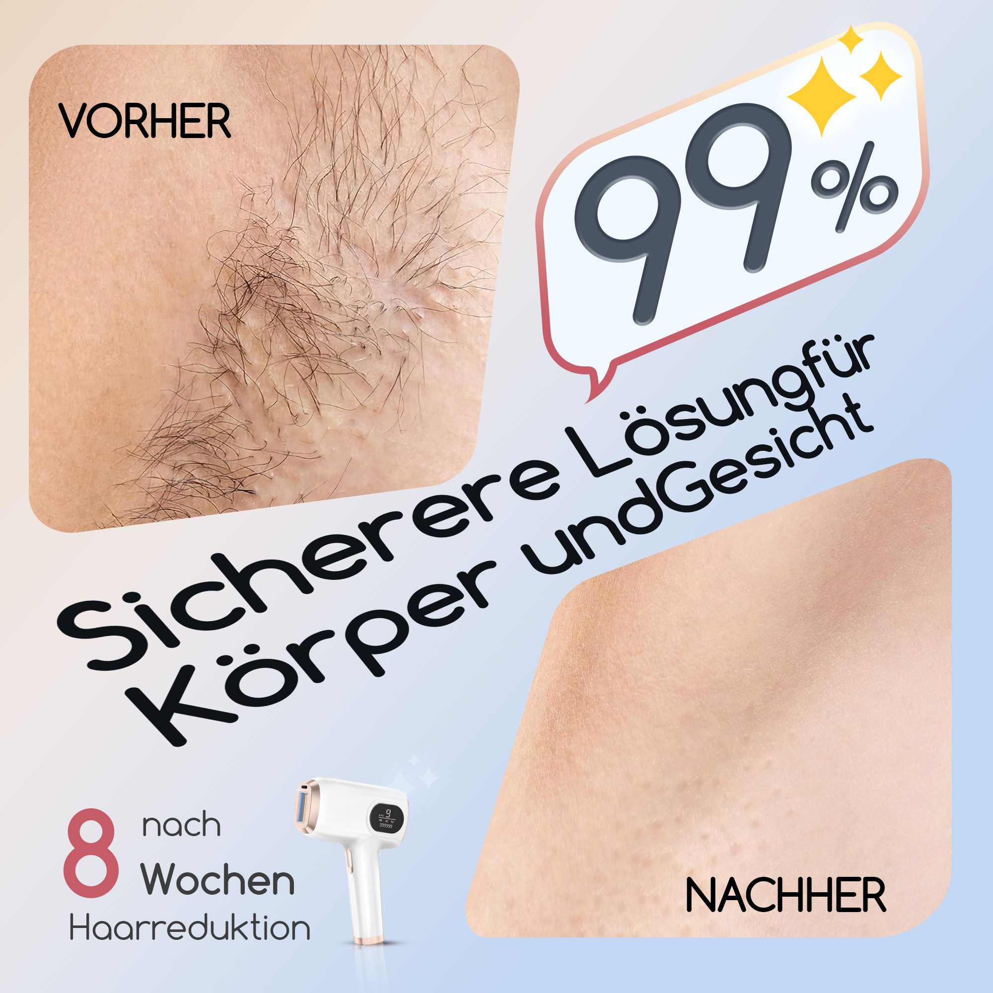 Vornix IPL-Haarentferner IPL Geräte Haarentfernung Laser haarentfernung Haarentfernungsgerät, 999,999 Lichtimpulse, Laser Haarentfernung Zuhause Dauerhafte Schm – Bild 5 von 5