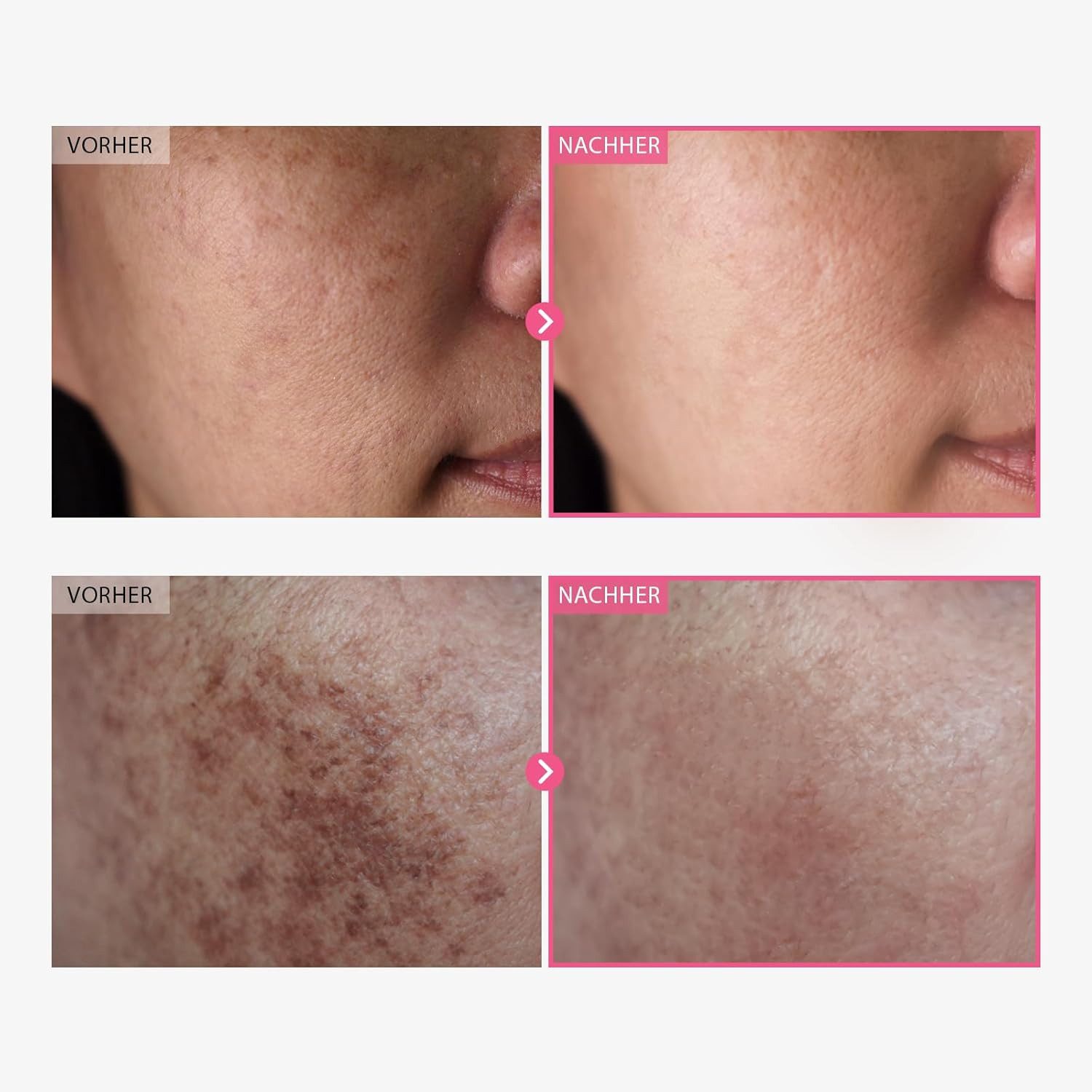 TOSOWOONG Hautcreme Strahlend ebenmäßige Haut mit Arbutin 7% + Tranexamsäure 4% für ungleichmäßigen Hautton, Koreanische Hautpflege