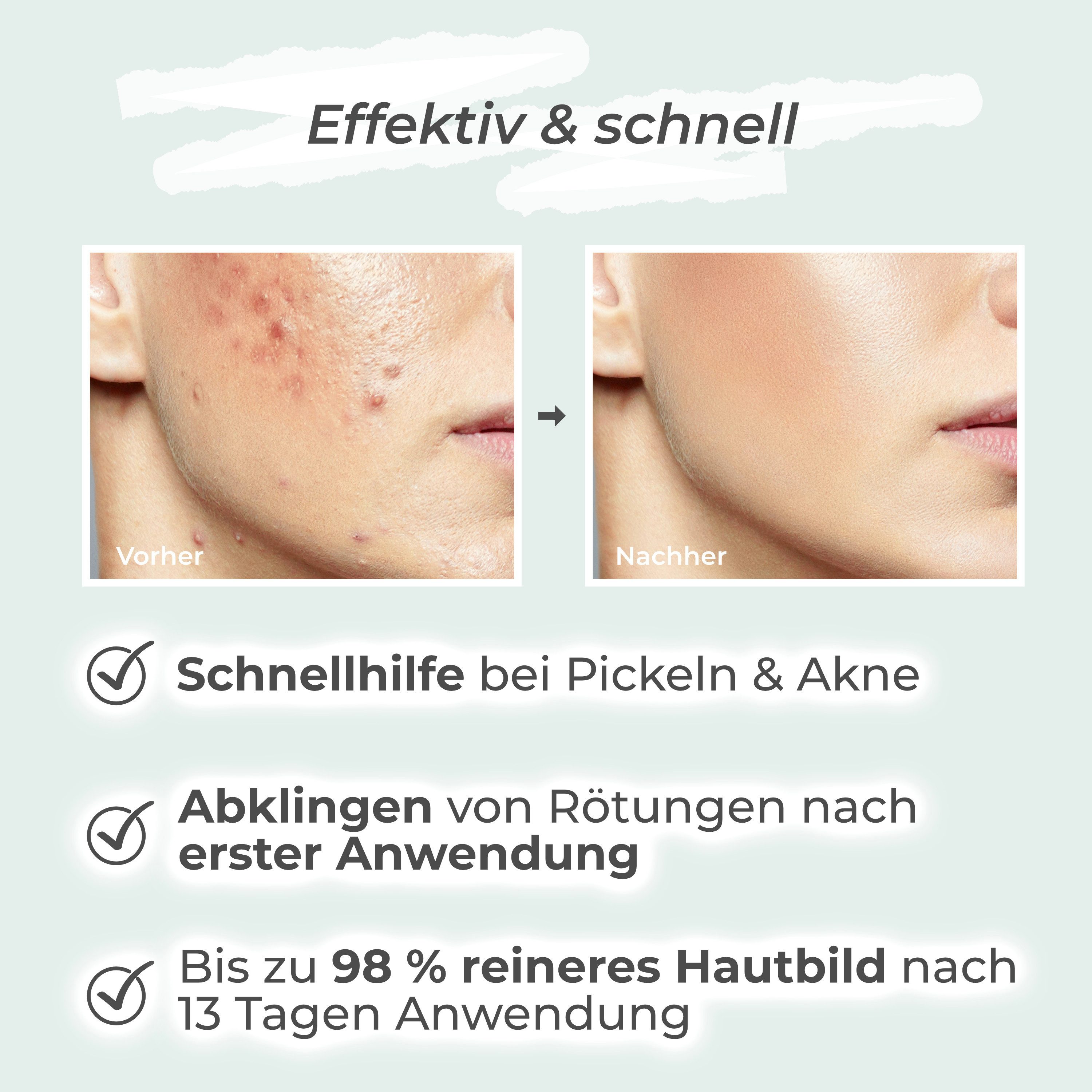Vigorous Cosmetics Gesichtspflege-Set Anti Akne Bundle gegen Akne, Pickel und Unreinheiten Spar-Set, Nach ca. 2 Wochen bis zu 98 % weniger Unreinheiten, Made in Germany