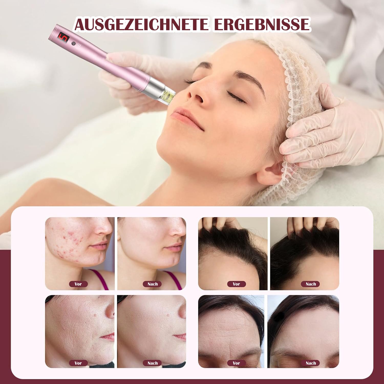 COOL-i ® Dermaroller Microneedling Pen mit Serum-Auftrag – Kabelloser, 5 Stufen, Serum gleichmäßig auf Gesicht und Körper auftragen.A3