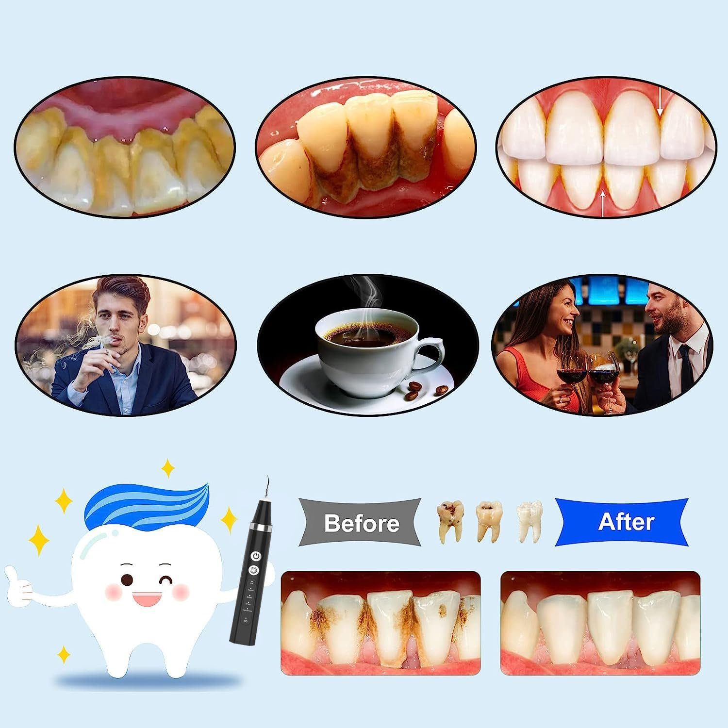 autolock Mundpflegecenter Zahnreiniger Elektrisch Zahnsteinentferner,5 Einstellbare Modi, 2 Reinigungsköpfe,Ultraschall IPX6 Wasserdicht,1500mah langlebig