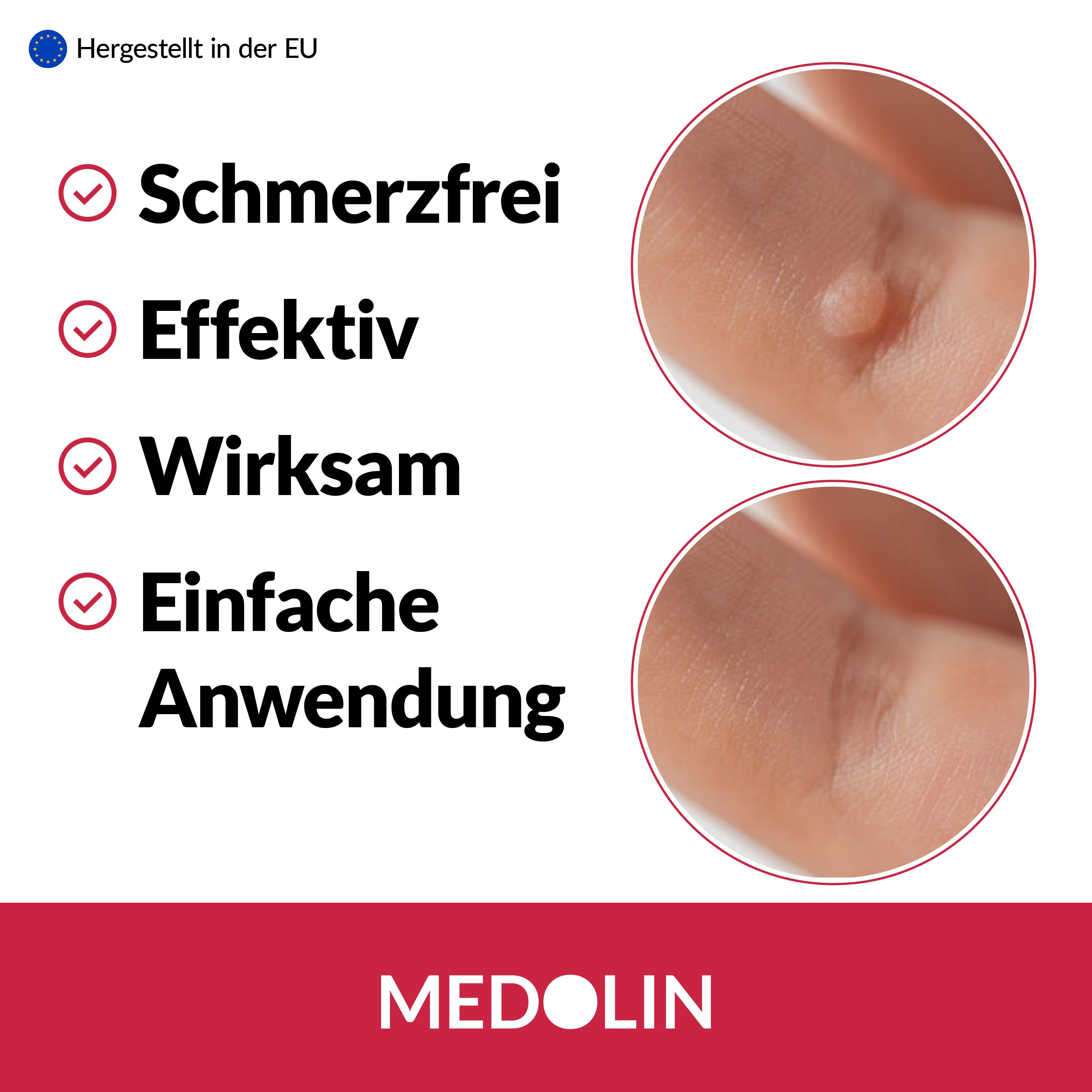 Medolin Warzen-Behandlungsstift Warzen Tinktur - Effektiver Warzenentferner - Mühelos Warzen entfernen, 1-tlg.