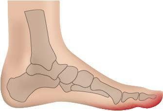 Fußgut Überbeinschutz Hallux Schutz mit Gelpolster, Set 2-tlg., Druckentlastung bei Hallux Valgus, Hallux Valgus Bandage