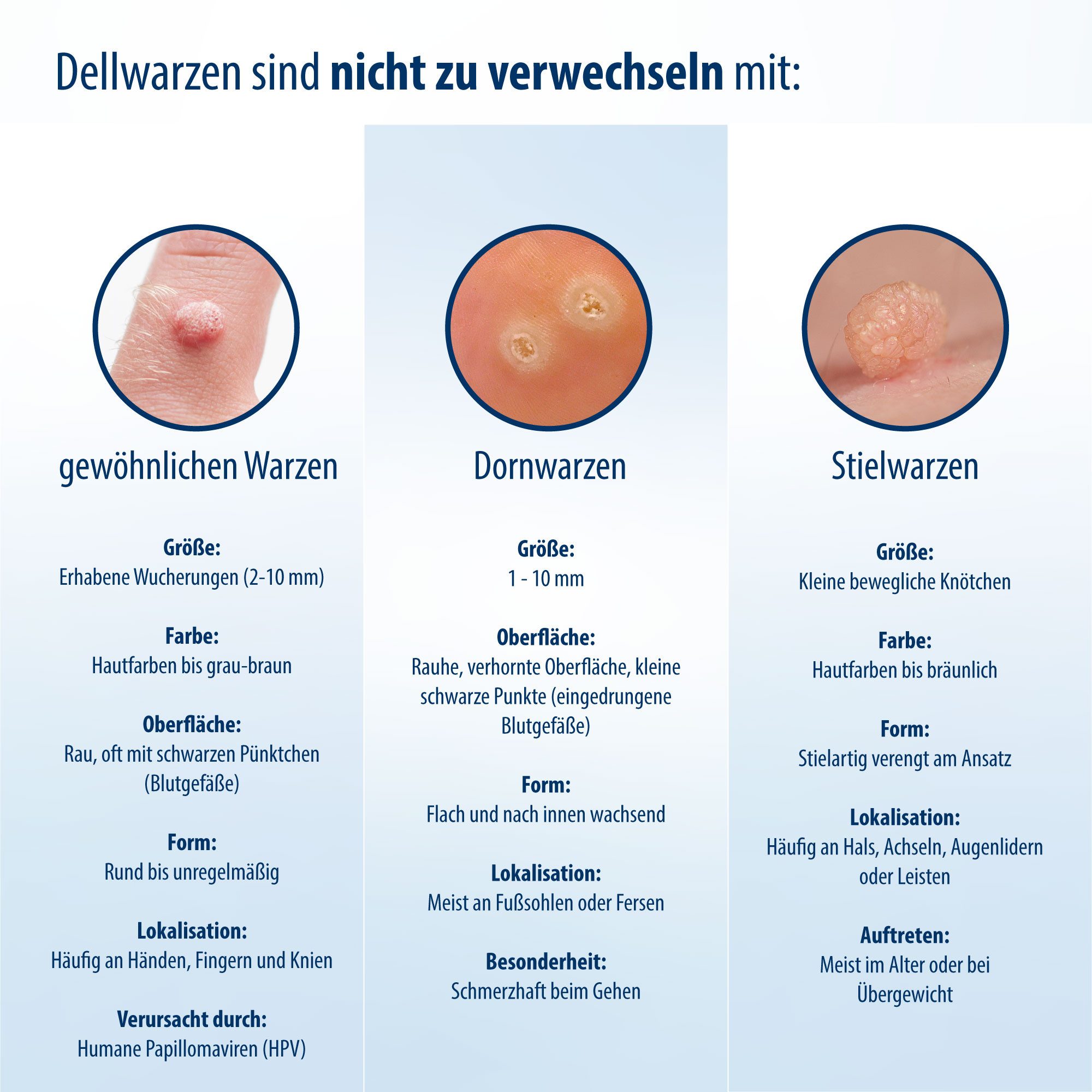 Evolsin Warzen-Behandlungsstift Evolsin® Dellwarzen Mittel I Sanfte & Effektive Dellwarzen Behandlung