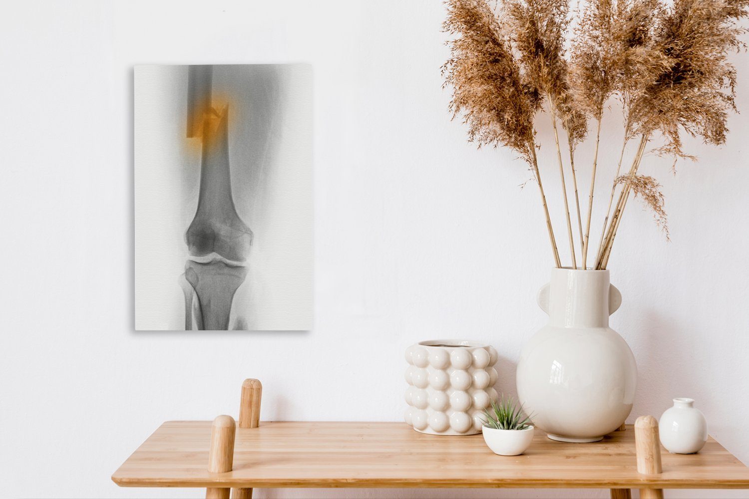 OneMillionCanvasses® Leinwandbild cm Röntgenbild Oberschenkels (1 des 20x30 St), bespannt einen, Leinwandbild eines Mannes, 30-jährigen inkl. Zackenaufhänger, Gemälde, fertig der in