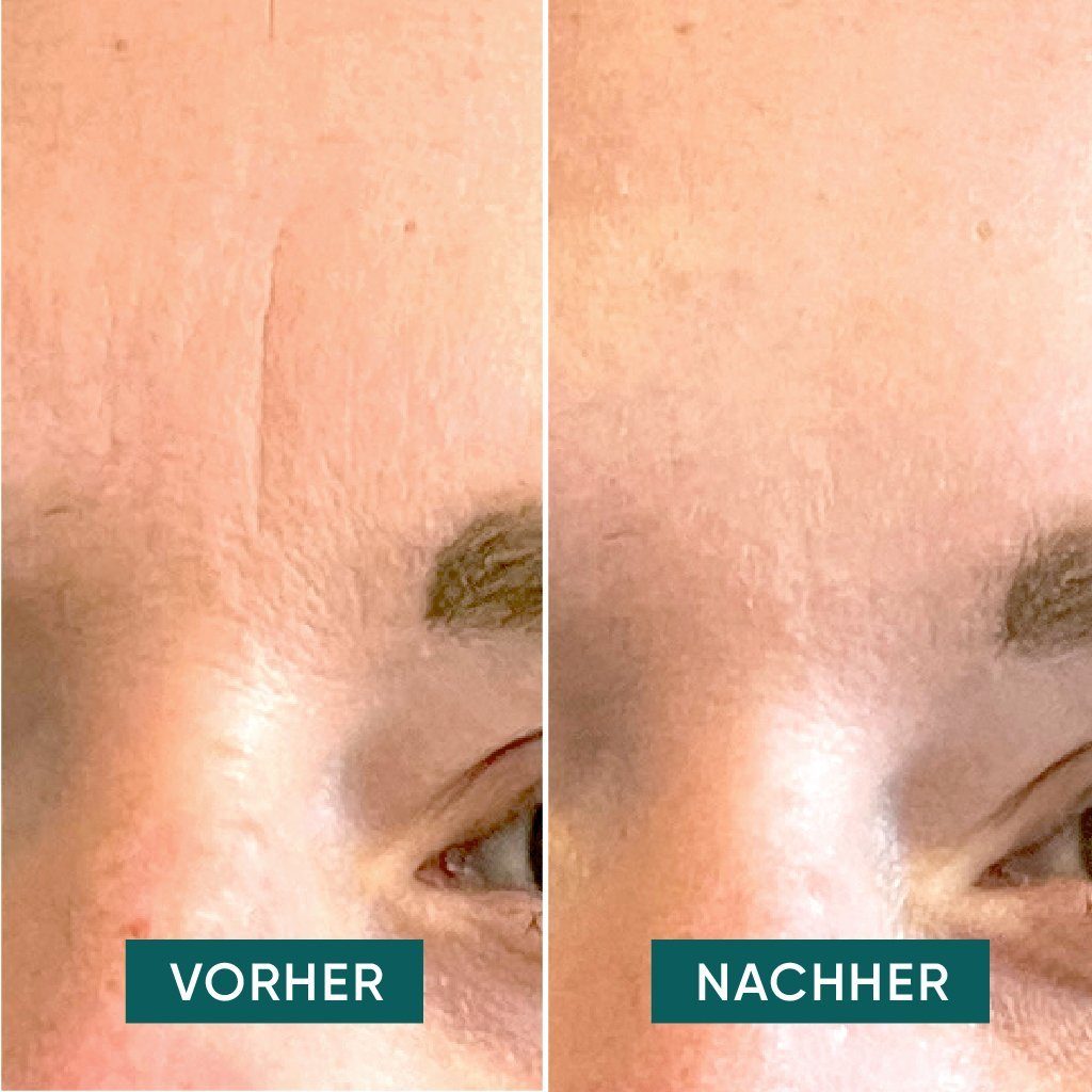 Hyaluron Zornesfalten APRICOT und Patches Augenpatches Beauty APRICOT® Facial gegen mit Stirn-