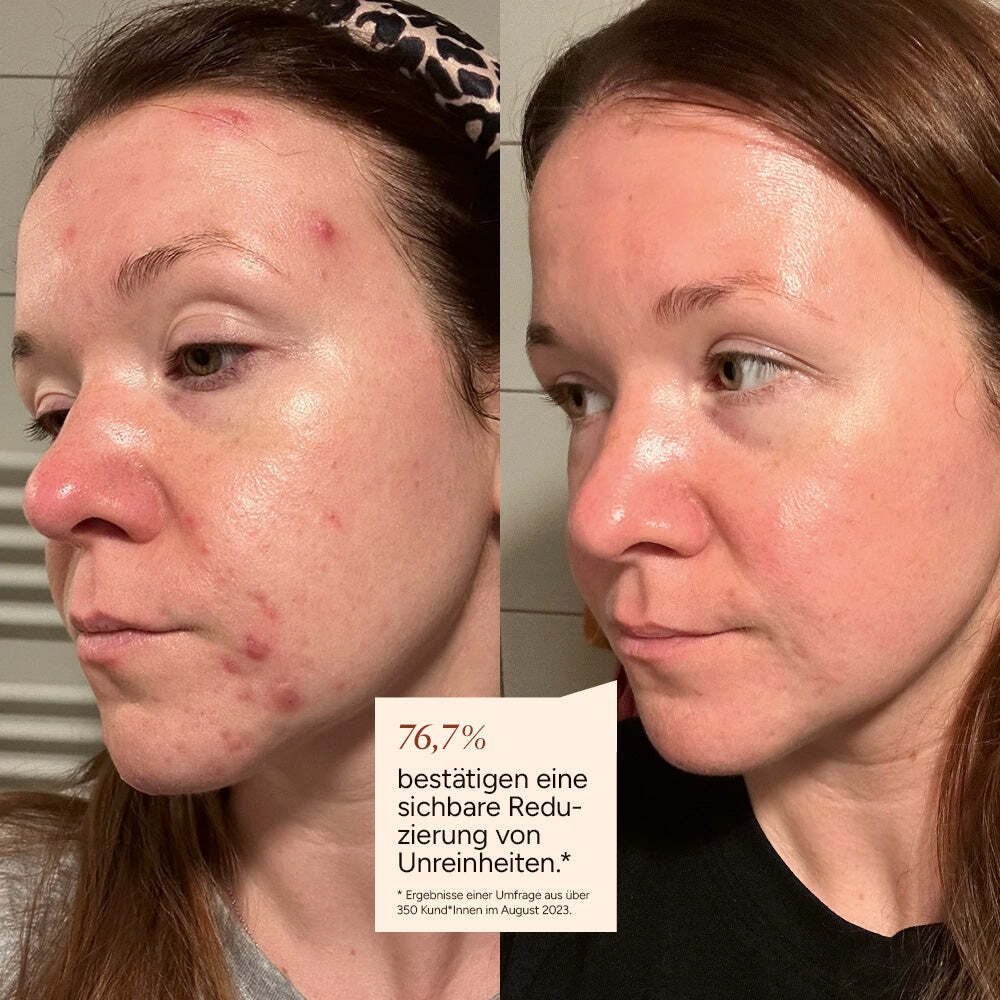 JUNGLÜCK Gesichtsserum Azelain Serum - 10% azelaic acid, 1-tlg., Wirkt gezielt gegen Unreinheiten