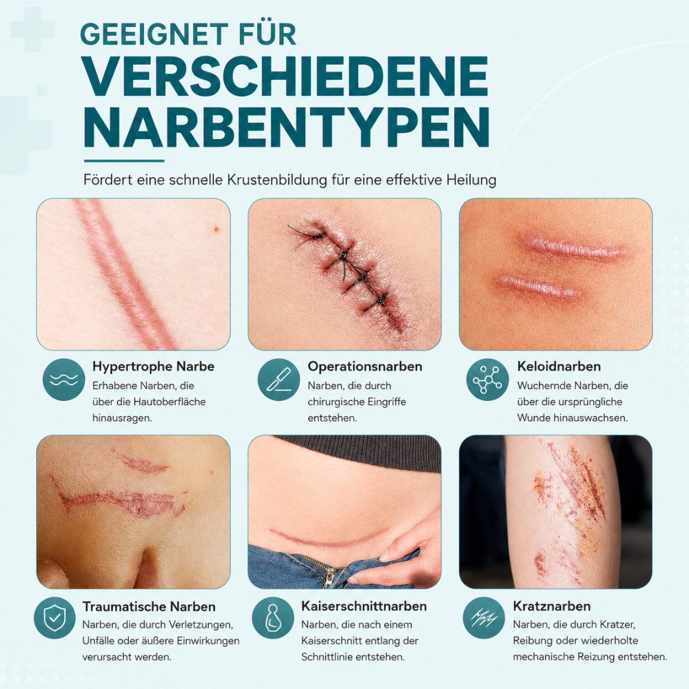 NEXGEN LUXUS SCHÖNHEIT & HAUTPFLEGE Wundpflaster Silikon Narbenpflaster Silicone Scar Sheets Scar Tape (4 cm x 190 cm), Deutsche Marke. Alte & Neue Narben, Hautfreundlich, Wiederverwendbar