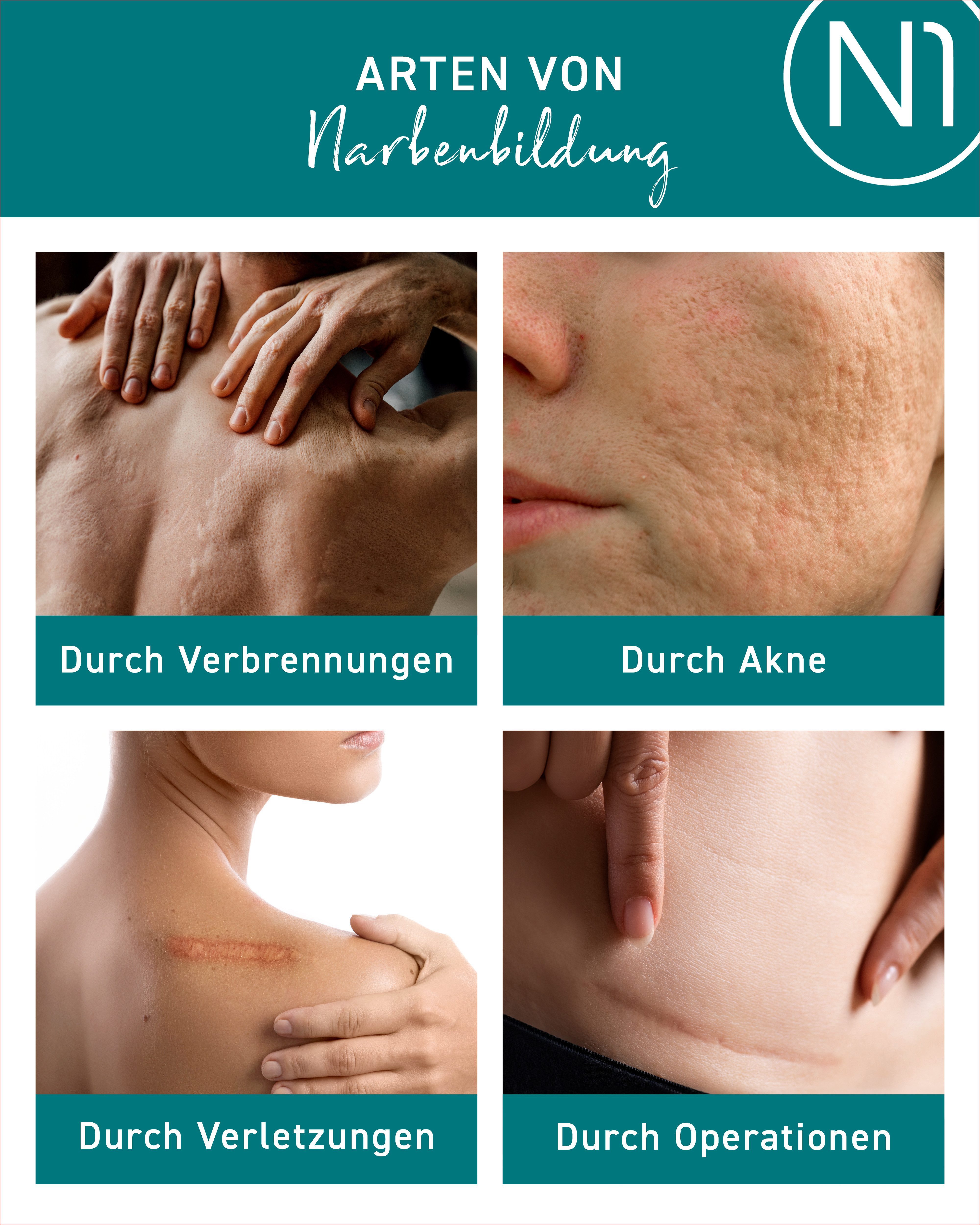 N1 Healthcare Hautpflegegel N1 Narben Gel, 19 g, Für neue und bis zu 2 Jahre alte Narben
