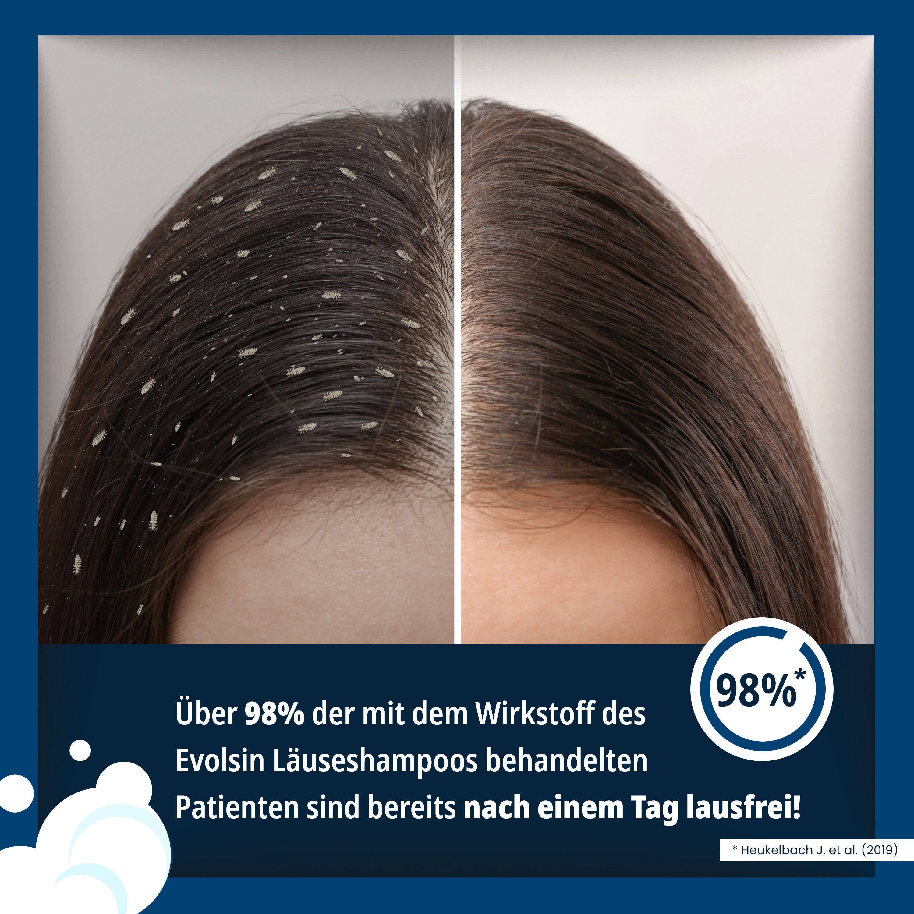 Evolsin Gelshampoo Läuseshampoo & Läusekamm für Erwachsene & Kinder ab 6 Monaten, Entfernt Kopfläuse