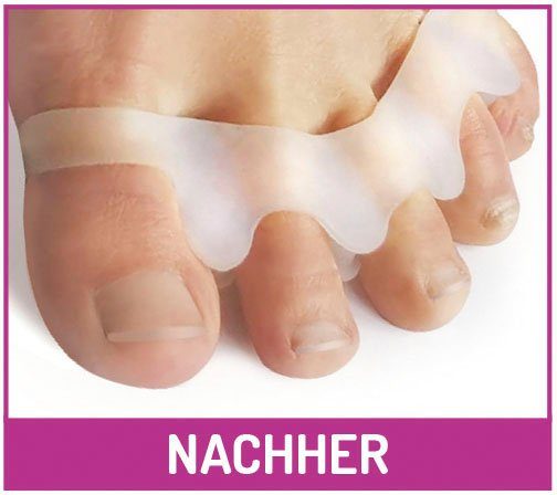 Fußgut Zehenkorrektor Zehen-Distanz-Schiene, gegen Druckstellen, Reibung, Blasen, Set 2-tlg., 1 Paar, hilfreich bei Zehenfehlstellungen, Hammerzehen, Hühneraugen