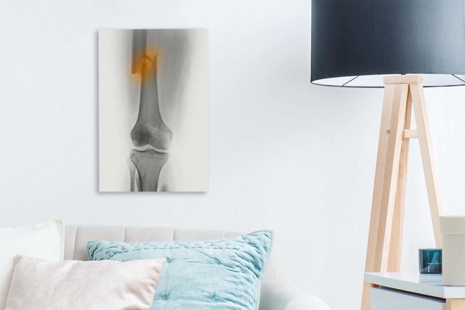 OneMillionCanvasses® Leinwandbild Röntgenbild des Oberschenkels in fertig bespannt einen, (1 St), 30-jährigen Mannes, Zackenaufhänger, eines Gemälde, 20x30 Leinwandbild cm inkl. der