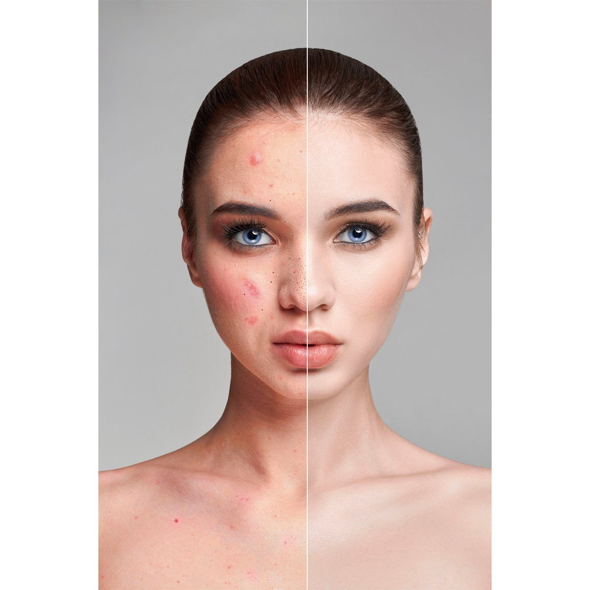 Velform® 4 Porensauger 6-tlg., Gesicht jugendliche Velform®️ Porenreiniger Clear, Vacu mit und Aufsätzen, saubere Haut