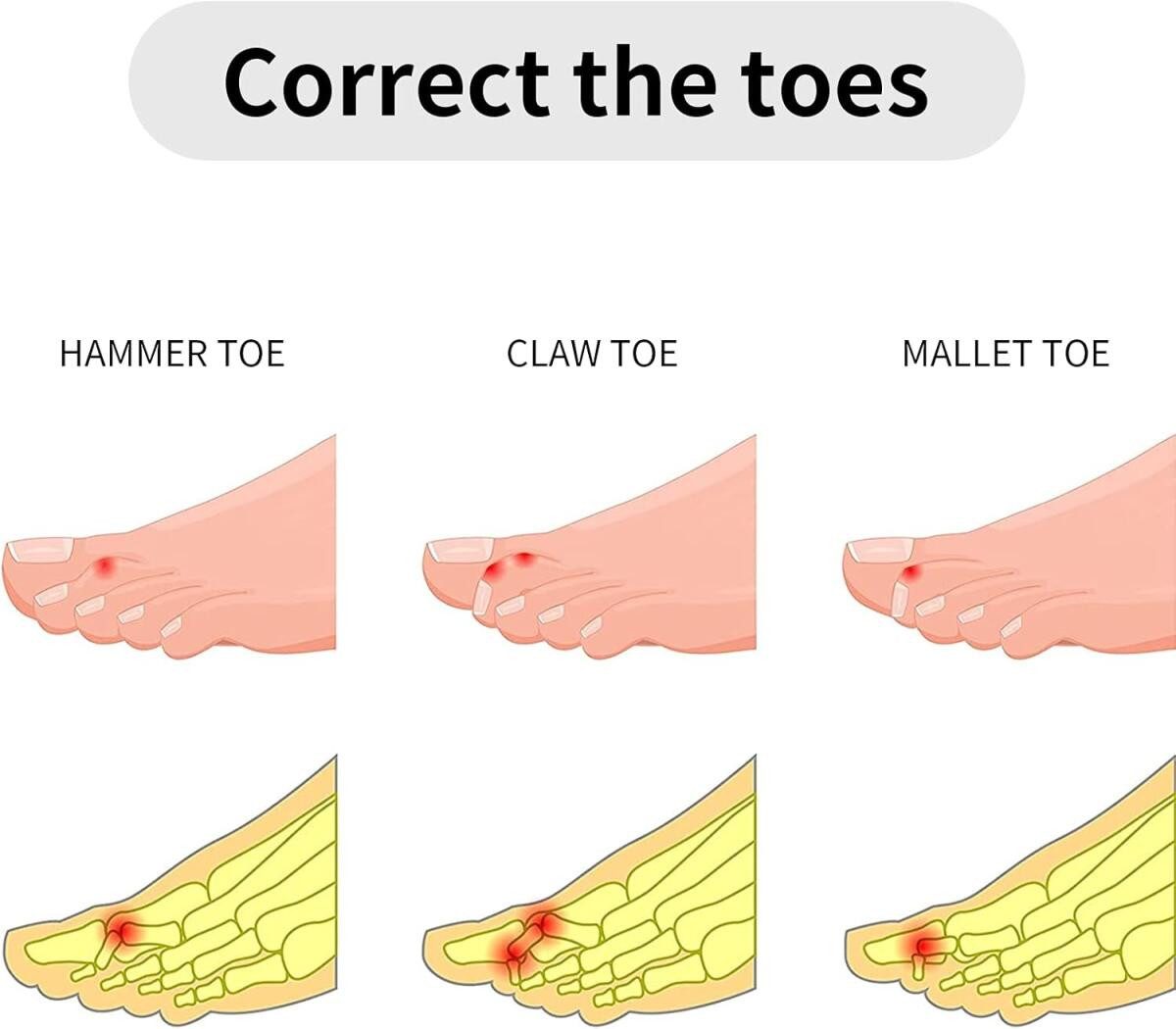 FELIXLEO Zehenkorrektor Hammerzehen Zeh Schiene 10 Stück Zehenbandage Toe Splints, 10-tlg.