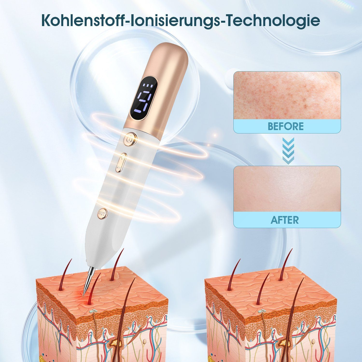 feinlux Dermaroller Mikrodermabrasionsgerät Muttermal Entfernen, set, Kosmetikbehandlungsgerät Professionelle Mole Entfernung Pen Kit, mit 9 Stärkenstufen und LCD-Bildschirm