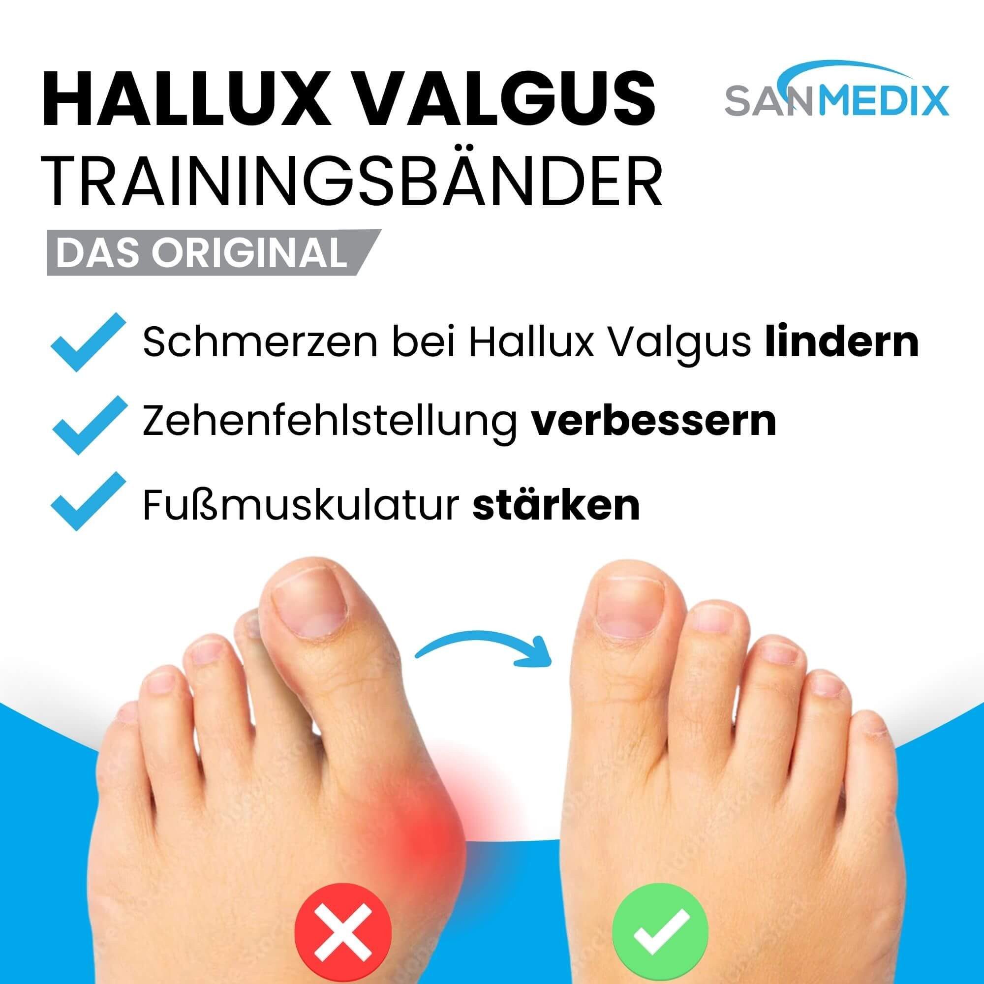 Sanmedix Zehenspreizer Hallux Valgus Korrektur Trainingsband für den Zeh, für Damen & Herren zur Schmerzlinderung von Ballenzehen