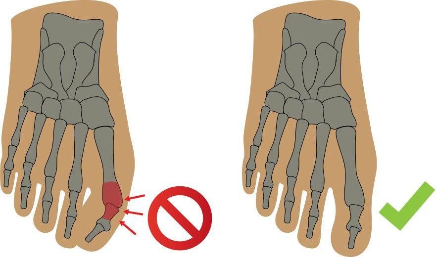 Fußgut Überbeinschutz Hallux Schutz mit Gelpolster, Set 2-tlg., Druckentlastung bei Hallux Valgus, Hallux Valgus Bandage