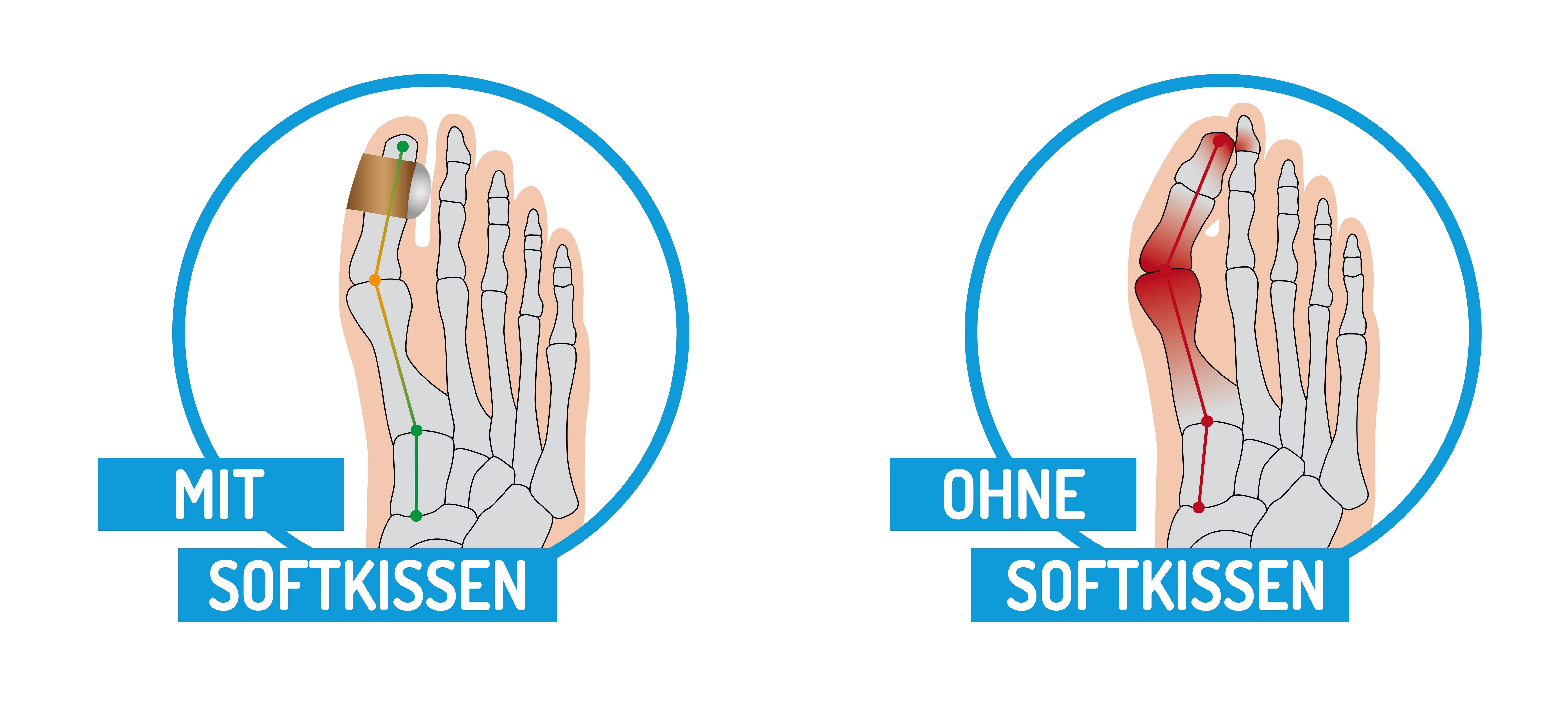 Fußgut Hallux-Bandage Softkissen mit Fixierband, verhindert Reiben, 2er Set, Druckentlastung bei Hühneraugen, Schwielen, Entlastung Hallux Valgus